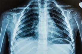 chest X ray photo